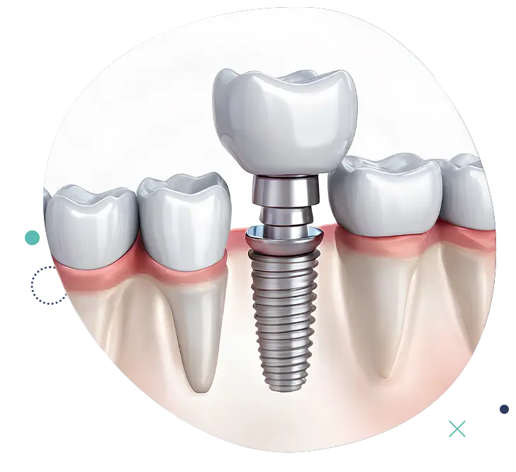 Immagine di un impianto dentale inserito tra i denti naturali