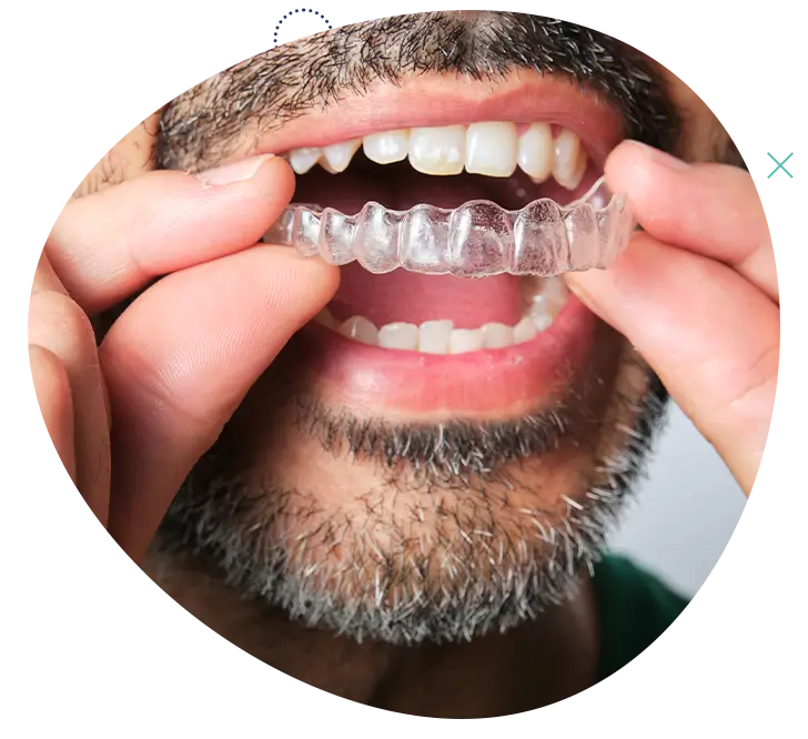 Uomo che inserisce un apparecchio ortodontico trasparente